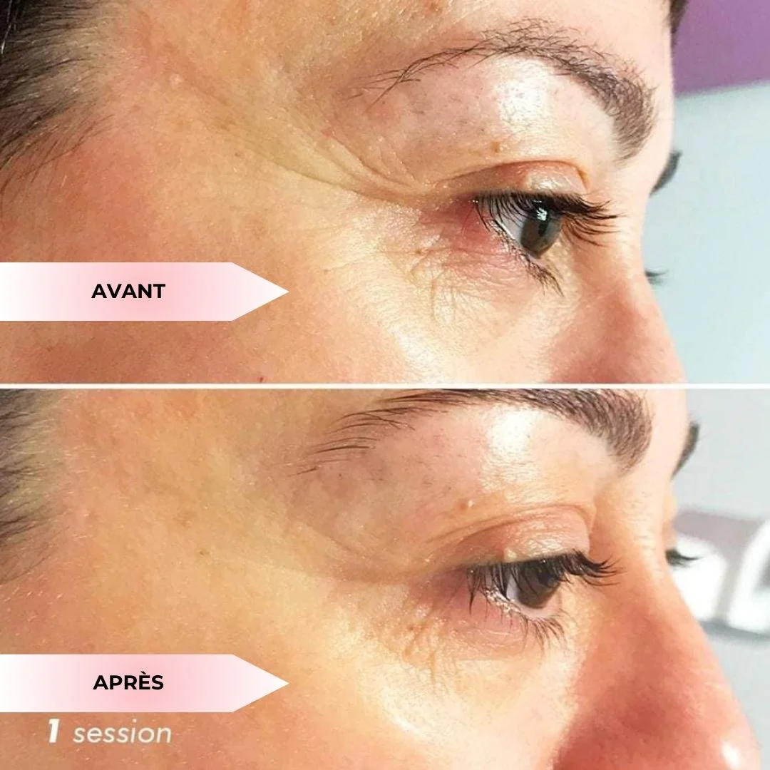 Pressothérapie occulaire